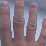 Защо пръстите са болезнени и подути: причините за тумора на ръцете