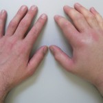 Защо пръстите са болезнени и подути: причините за тумора на ръцете