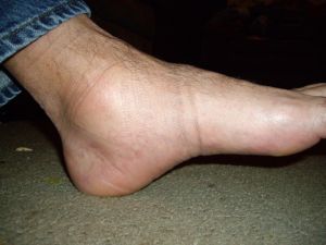Защо подути крака в краката: причини и лечение