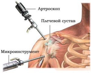 Акромиоклавикуларна артроза, в резултат на травма или износване на ставите
