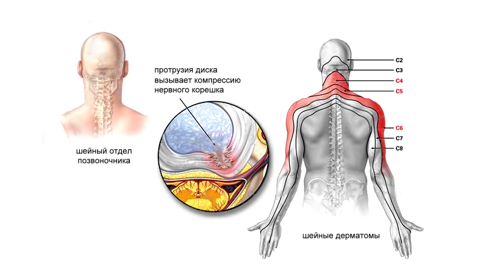 Проток на цервикалния гръбнак (С4-С5 и С6-С7)