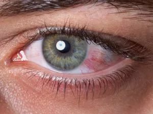 Сухи очи. Симптоми на синдрома на сухото око. Причини за сухота в очите, диагноза и лечение на патологията. Какви капки капе със сухо око?