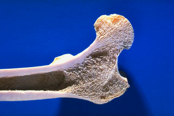 Еностоза на бедрената кост, илиакия, ребрата и гръбнака