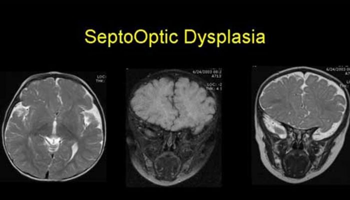 Септопсихиазмална, септооптична дисплазия на мозъка