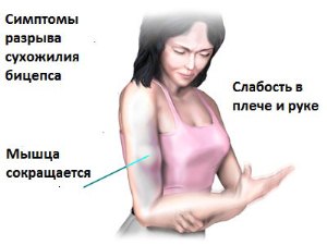 Симптоми и лечение на контузия на рамото и предмишницата