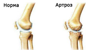 Причини, симптоми и лечение на артрит на артрозата