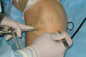 Лечение на коляното с хондропластика