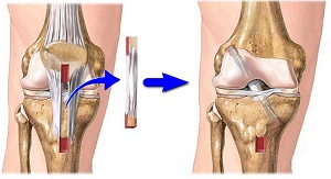 Какви операции се извършват на колянната става