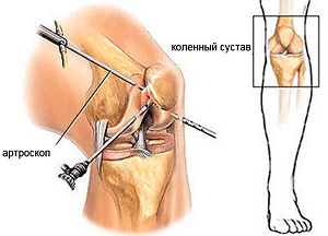Какви операции се извършват на колянната става