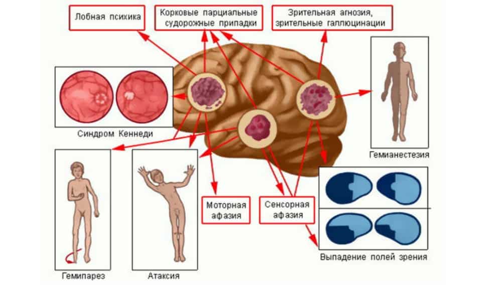 Как да различаваме главоболие от рак на мозъка от други цефалози?