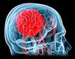 Какви са главоболията за мозъчен тумор: честота, природа, локализация