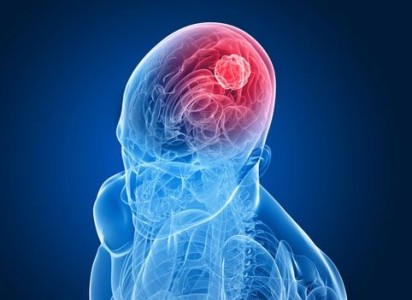 Какви са главоболията за мозъчен тумор: честота, природа, локализация