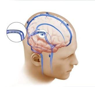 Причини и методи за лечение на натискане на главоболие в областта на шията