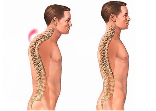 Причини за появата, класификацията, лечението на хиперкипофизата на гръдния стълб