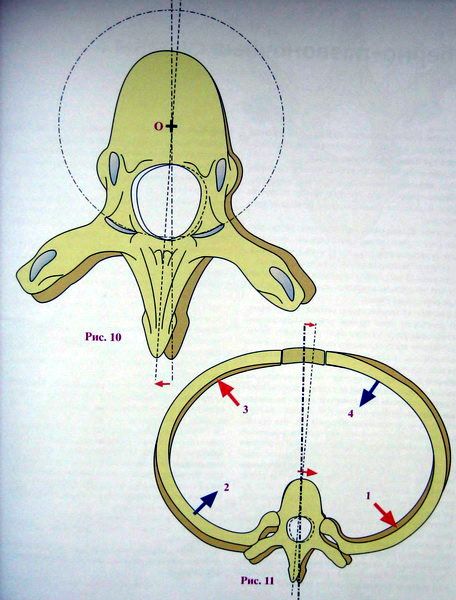 Причини за развитие и характеристики на въртенето на гръбначните тела