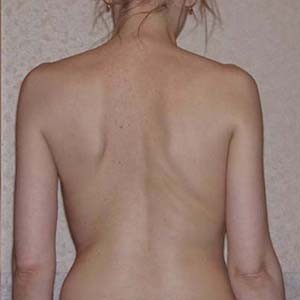 Причини за развитие, симптоми и лечение на сколиоза на гръбначния стълб на 2-ра степен