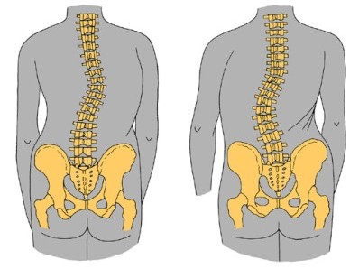 Причини, симптоми, признаци на сколиоза на гръбначния стълб