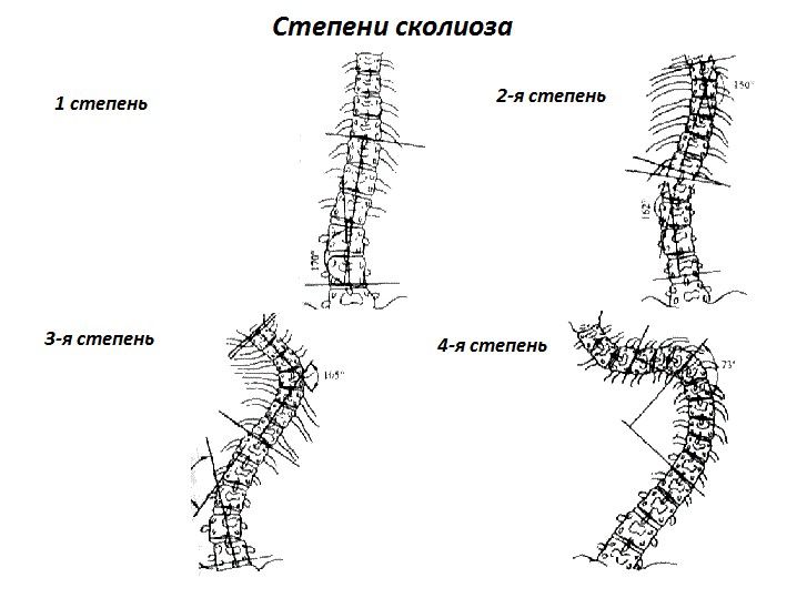 Класификация на сколиозата по отношение на степени, видове и етапи