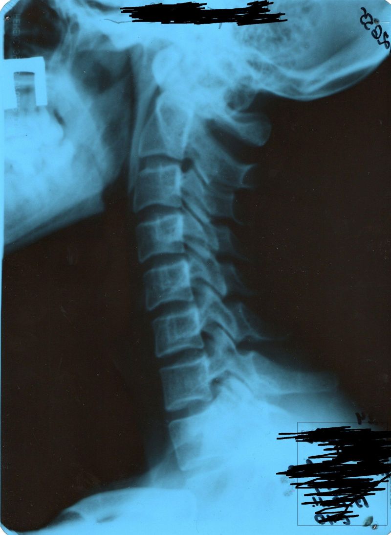 Характеристики на развитието и лечението на глипордоза на цервикалната и лумбалната част на гръбначния стълб