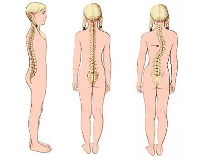 Как се проявява и лекува вродената сколиоза на гръбначния стълб?