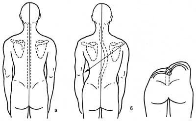 Как да се лекува дясната страна на лумбалната и гръдната сколиоза 1, 2 градуса