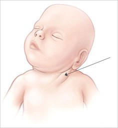 Кривошея при новородени: симптоми, признаци, причини, лечение