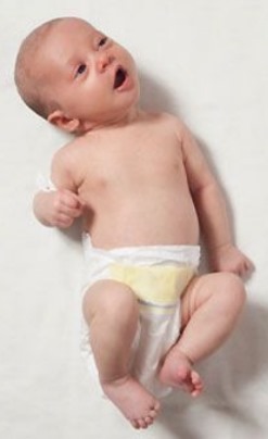 Кривошея при новородени: симптоми, признаци, причини, лечение