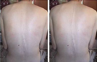 Лево- и дясна сколиоза на гръбначния стълб: симптоми, лечение
