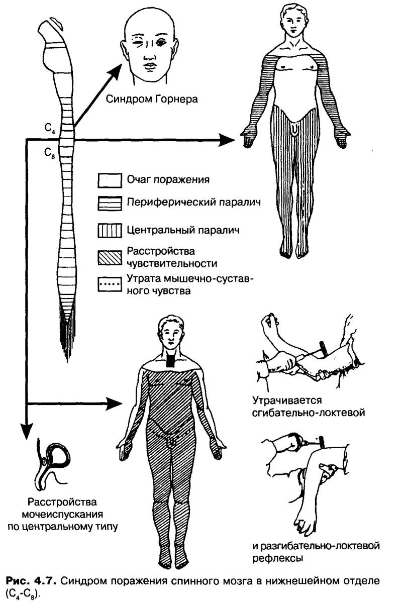 Симптоми и лечение на патологична кифоза на гръбначния стълб