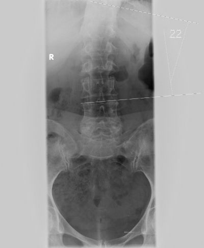 Видове и прояви на дясната и лявата странична thoracolumbar сколиоза 1, 2, 3, 4 градуса