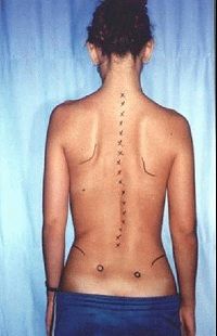 Видове, симптоми и лечение на сколиоза на лумбалния гръбначен стълб