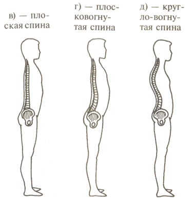 Какво представлява плосъкът на гърба и как се лекува?