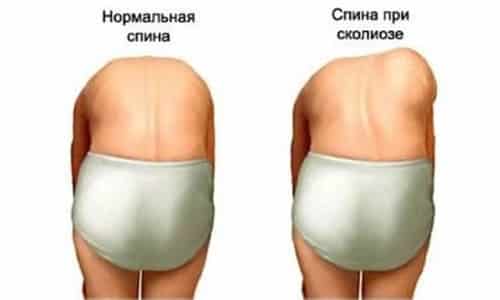 Видове деформации на гръбнака, техните признаци и лечение