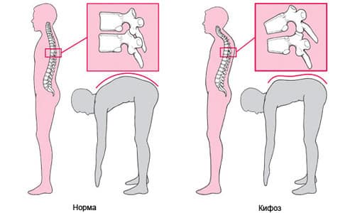 Видове деформации на гръбнака, техните признаци и лечение