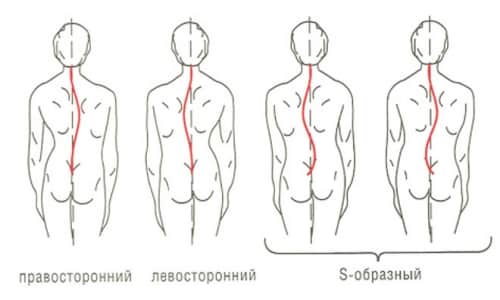 Причини, симптоми и лечение на сфеноидна деформация на гръбначните тела