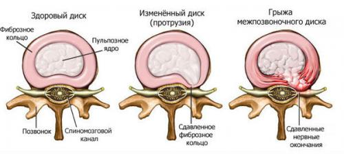 Причини за болка в гърба от дясната страна