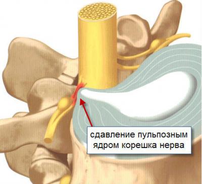 Причини за силна болка в лумбалната област и методи за контролиране на нея