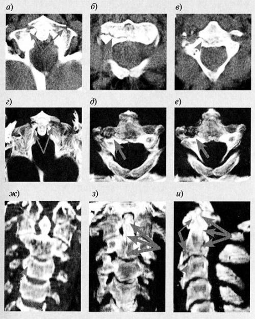 Компютърна томография (CT) на гръбначния стълб