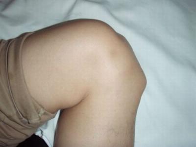 Възможни причини за болка в колянната става при огъване