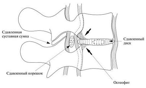 Симптомите на херния на различни части на гръбначния стълб