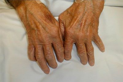 Основните симптоми на ревматоиден артрит
