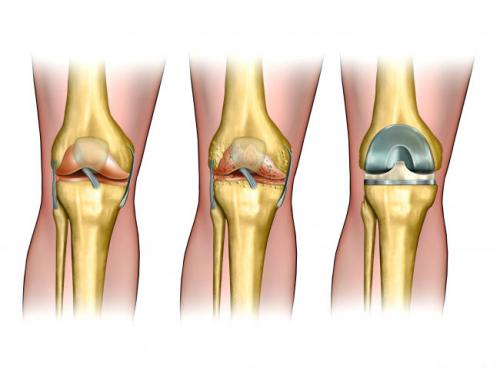 Най-честите причини за болка в колянната става