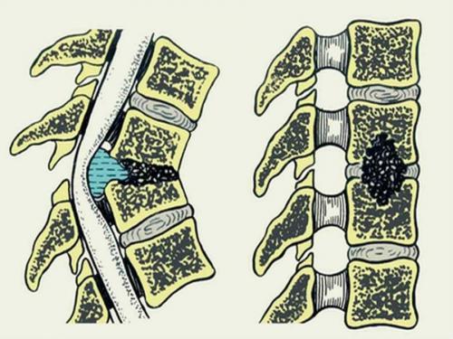 Най-честите причини за нараняване на гърба