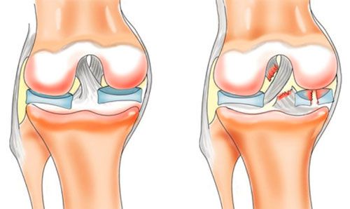 Болка в коляното : причини и лечение | Компетентно за здравето на Move&Flex