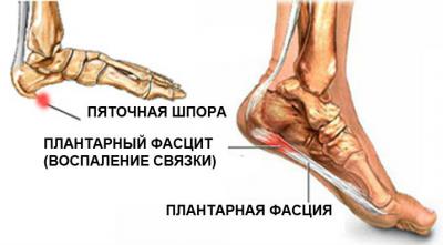 Защо има болка в стъпалата на краката: основните причини