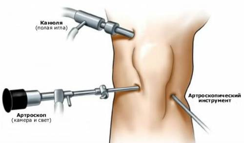 Артроскопия на колянната става - каква е тази операция?