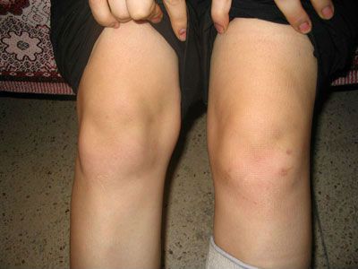 Артроскопия на колянната става - каква е тази операция?