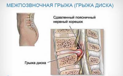 Причини за остра болка в гърба