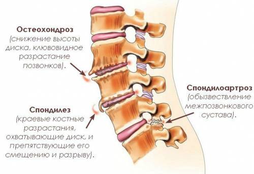 Причини за болка в гръбначния стълб