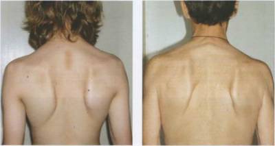 Причини за болки в гърба между раменните остриета